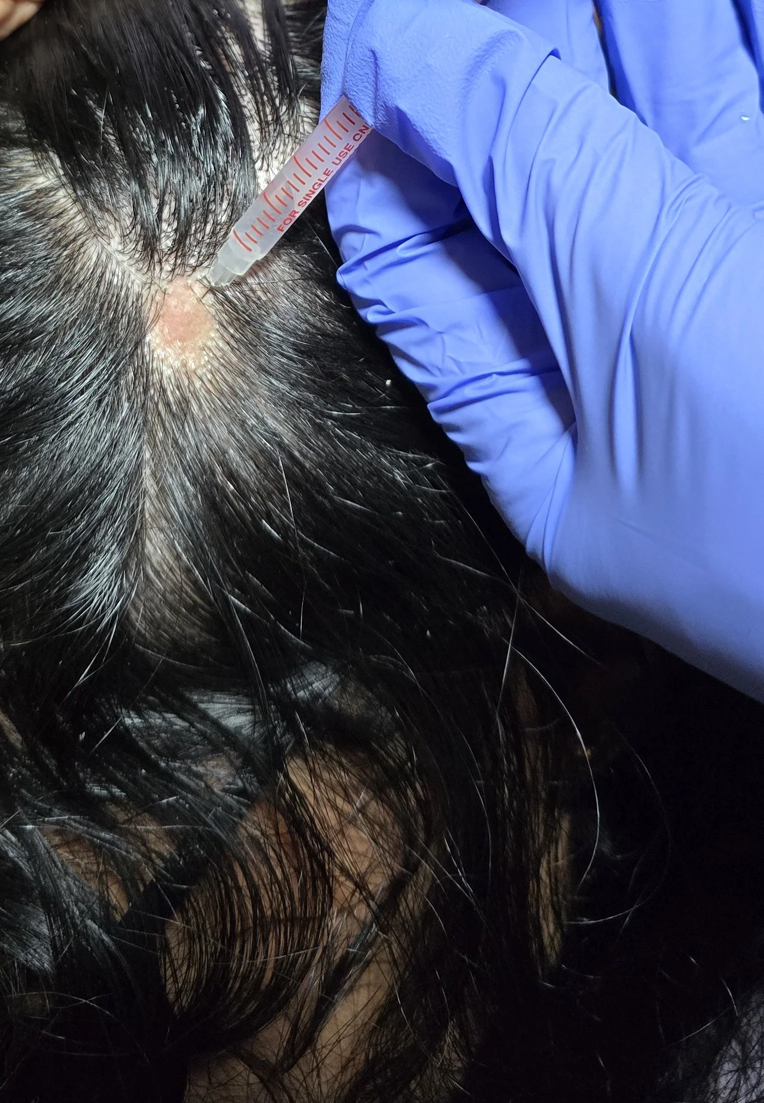 Dermatologist at DermaVue clinic examining a patient with alopecia areata hair loss patches during a consultation