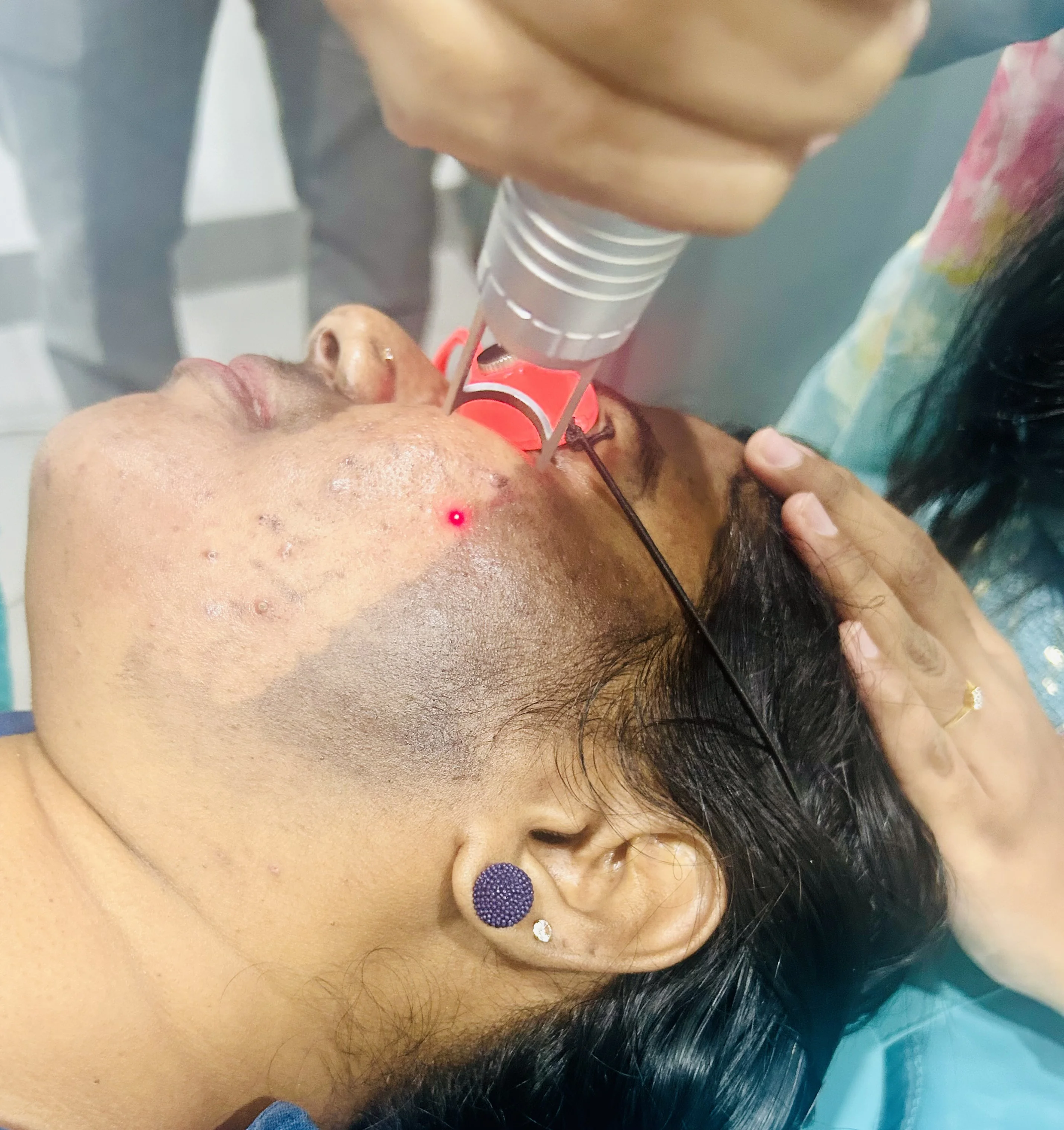 Dermatologist performing carbon laser facial treatment at DermaVue Coimbatore clinic in Gandhipuram