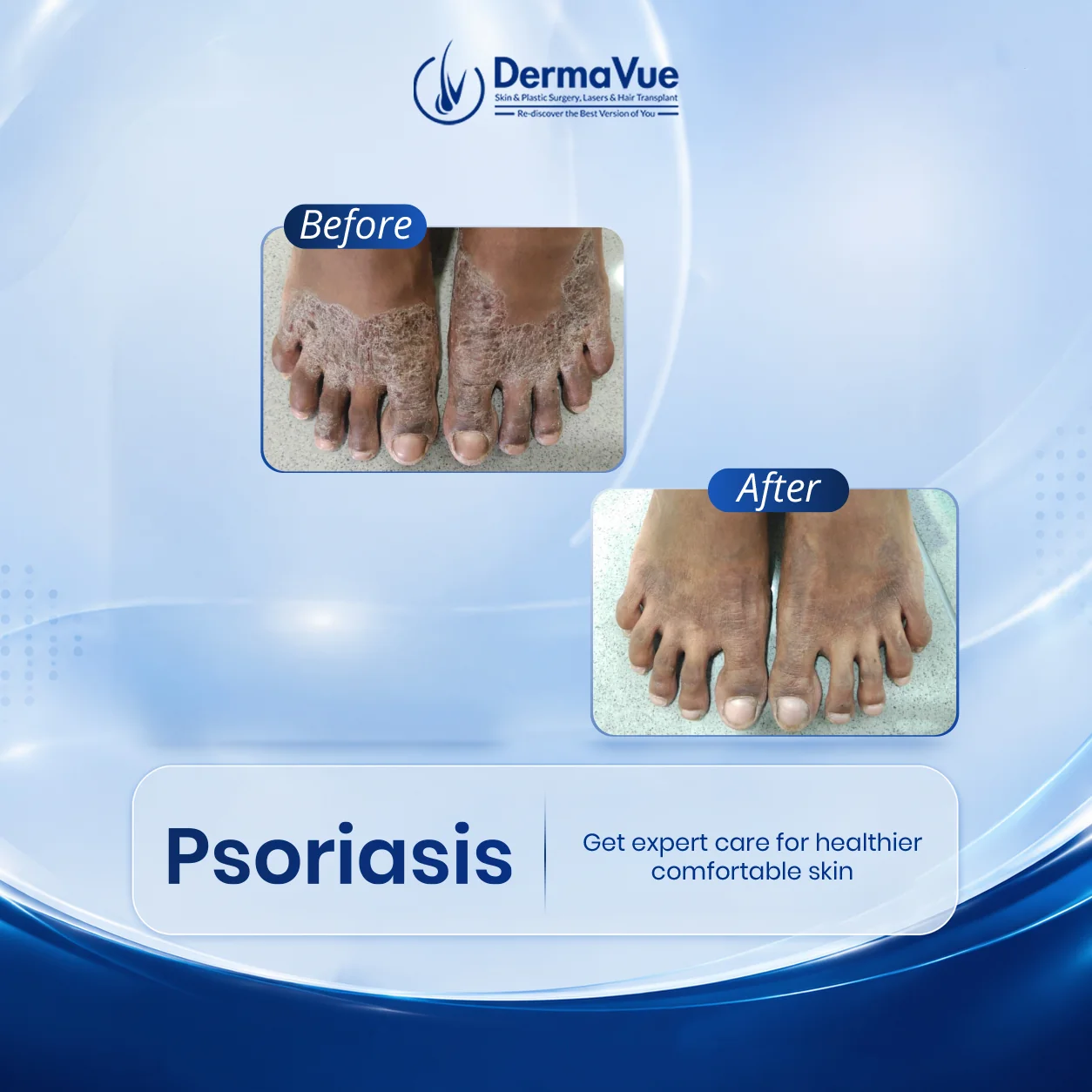 Dermatologist at DermaVue Kerala clinic examining a patient with psoriasis skin condition during a consultation