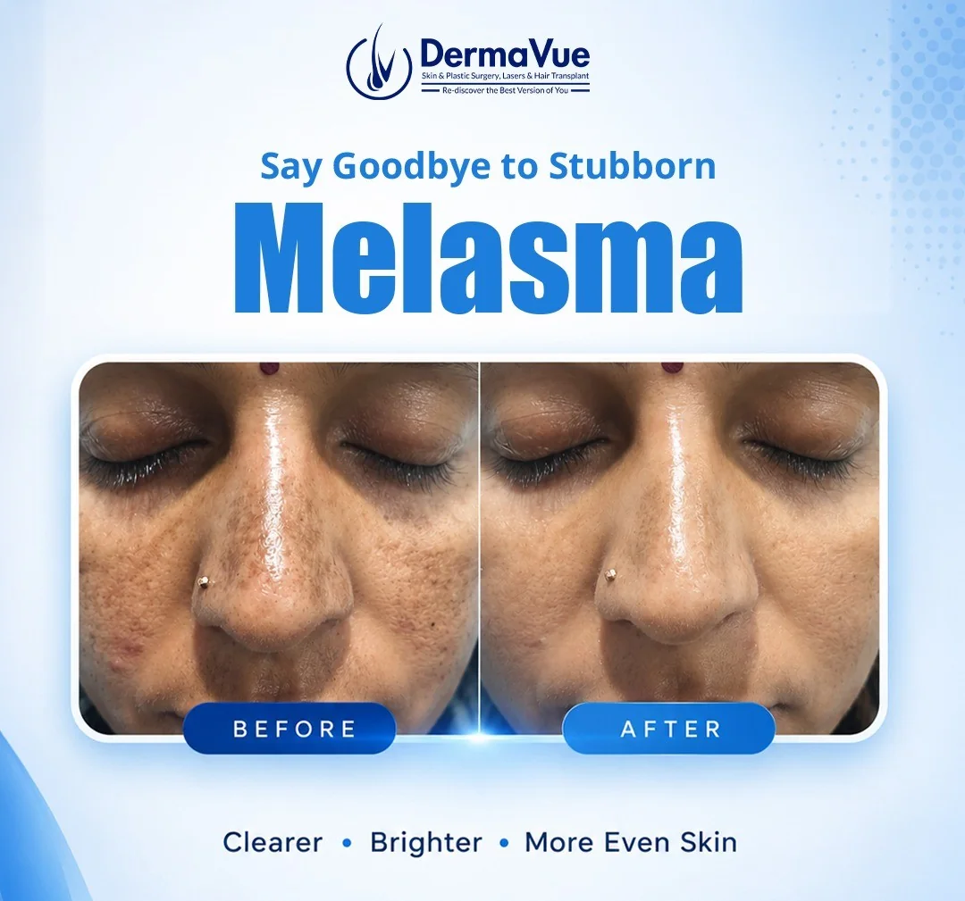 Dermatologist at DermaVue clinic examining a patient with melasma pigmentation during a consultation