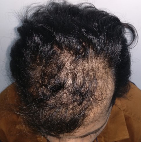 Top hair transplant center in Trivandrum  DermaVue