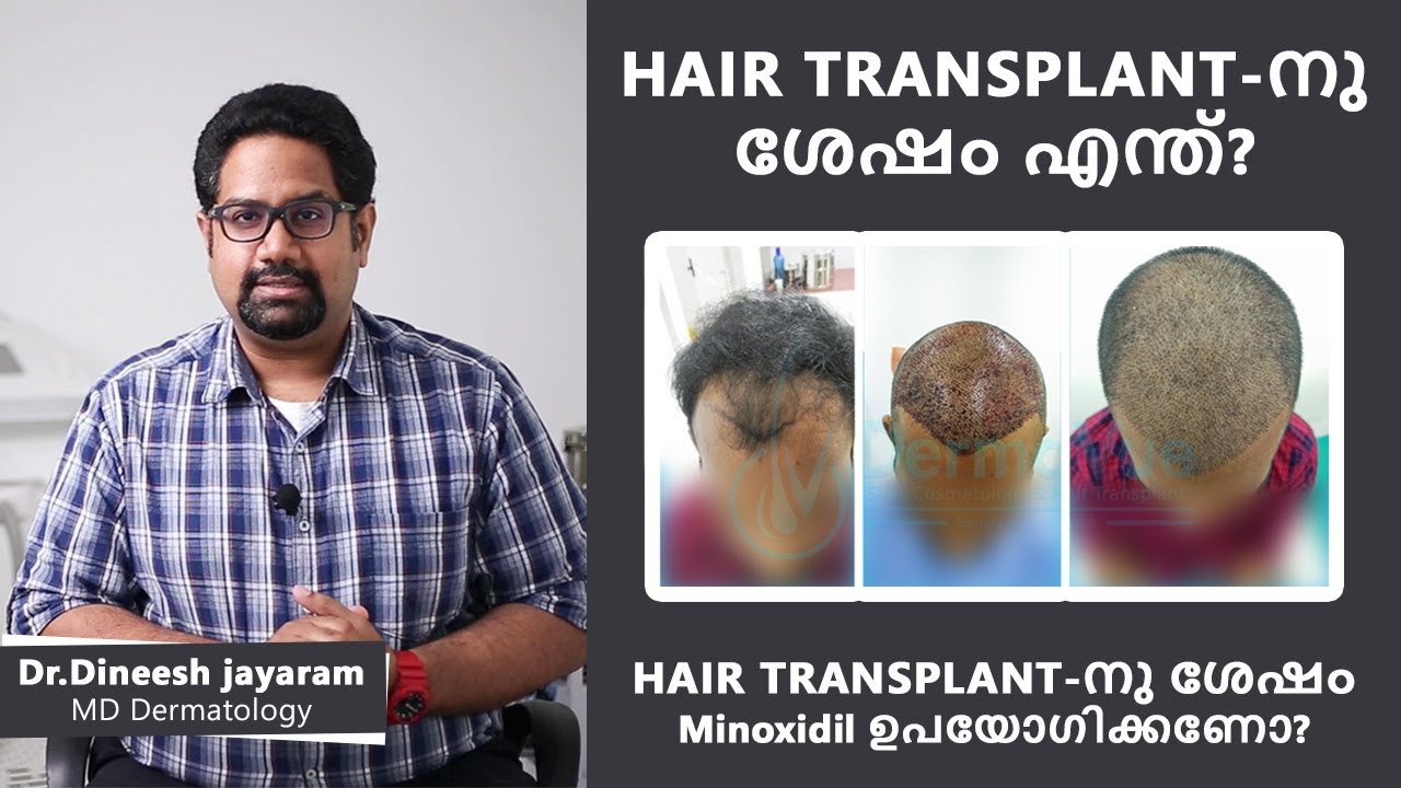 Hair Transplant Clinic in Kottayam  Best Hair Transplant Surgeon in  Kottayam  Hair O Craft