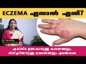 Eczema
