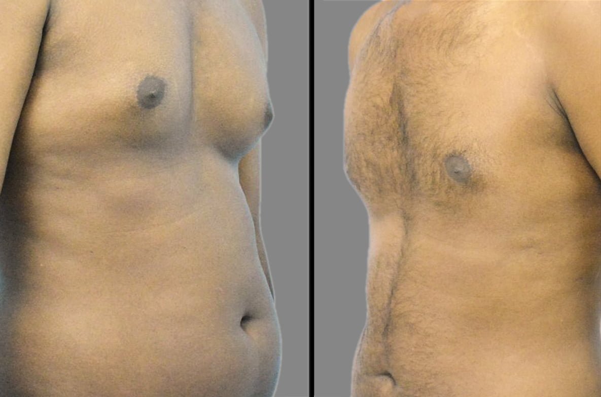 Gynecomastia Solutions: Restoring Confidence and Masculinity