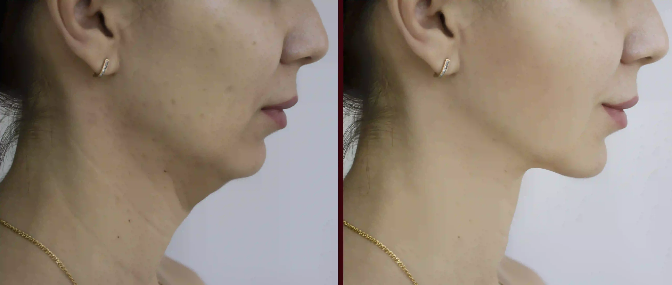 Non-Surgical Jawline and Chin Contouring at DermaVue