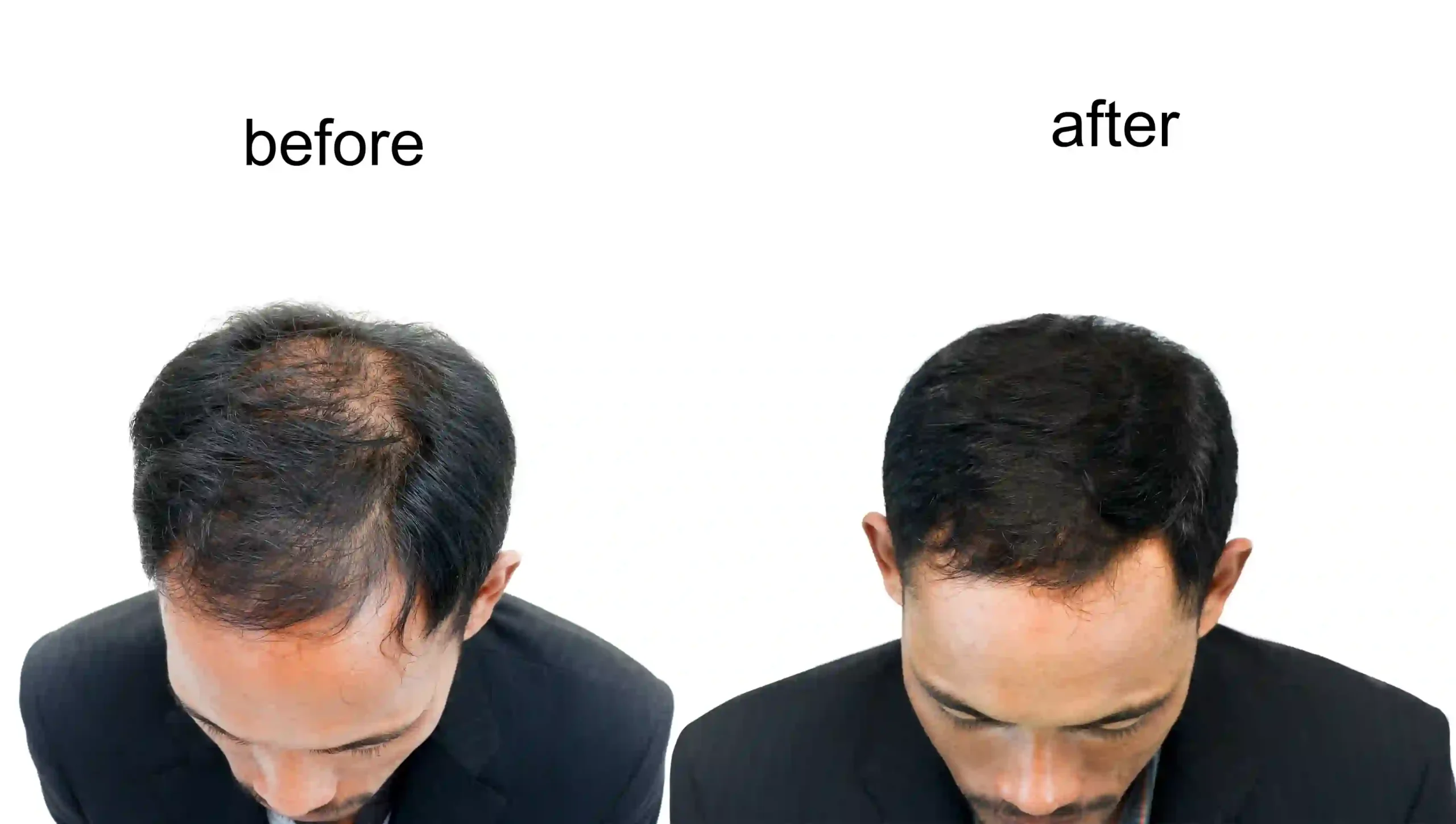 GFC PRP Applications at DermaVue: Advanced Hair Restoration, Superior Skin Revitalization, Scar & Stretch Mark Minimization
