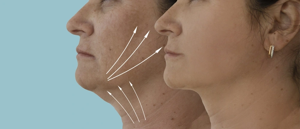 Key Benefits of Double Chin Reduction - Discover Effective Solutions for a Defined Jawline at Dermavue