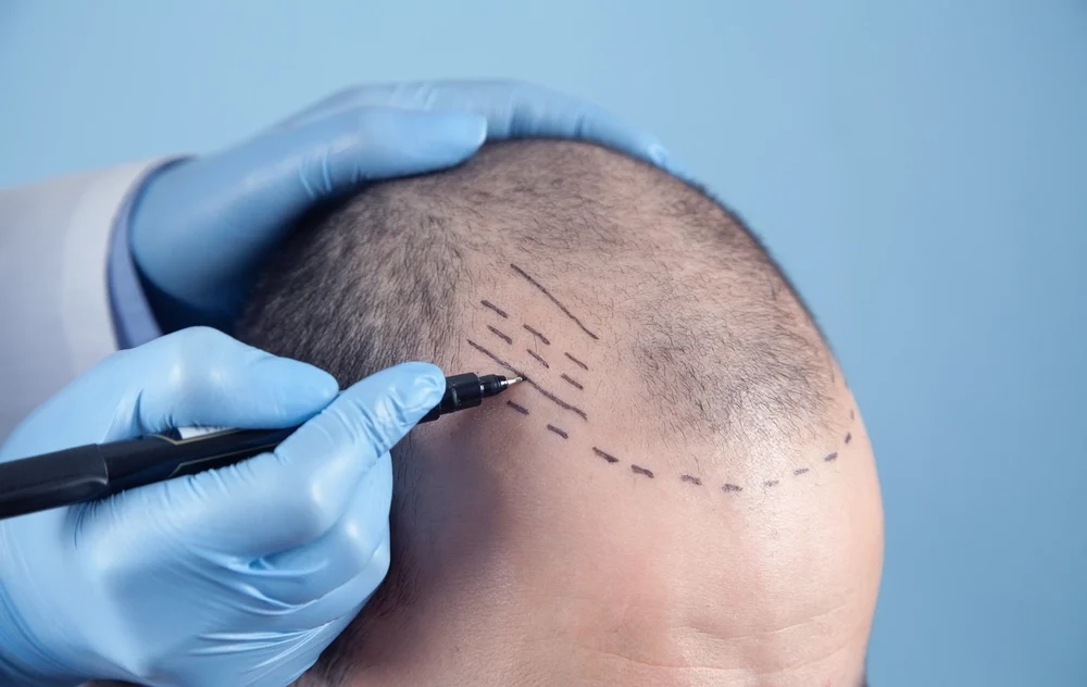 SMART FUE Hair Transplant procedure - Your Natural Hair Restoration Solution