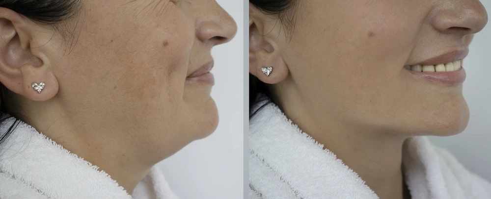Jaw Surgery Augmentation at DermaVue - Enhance Your Profile