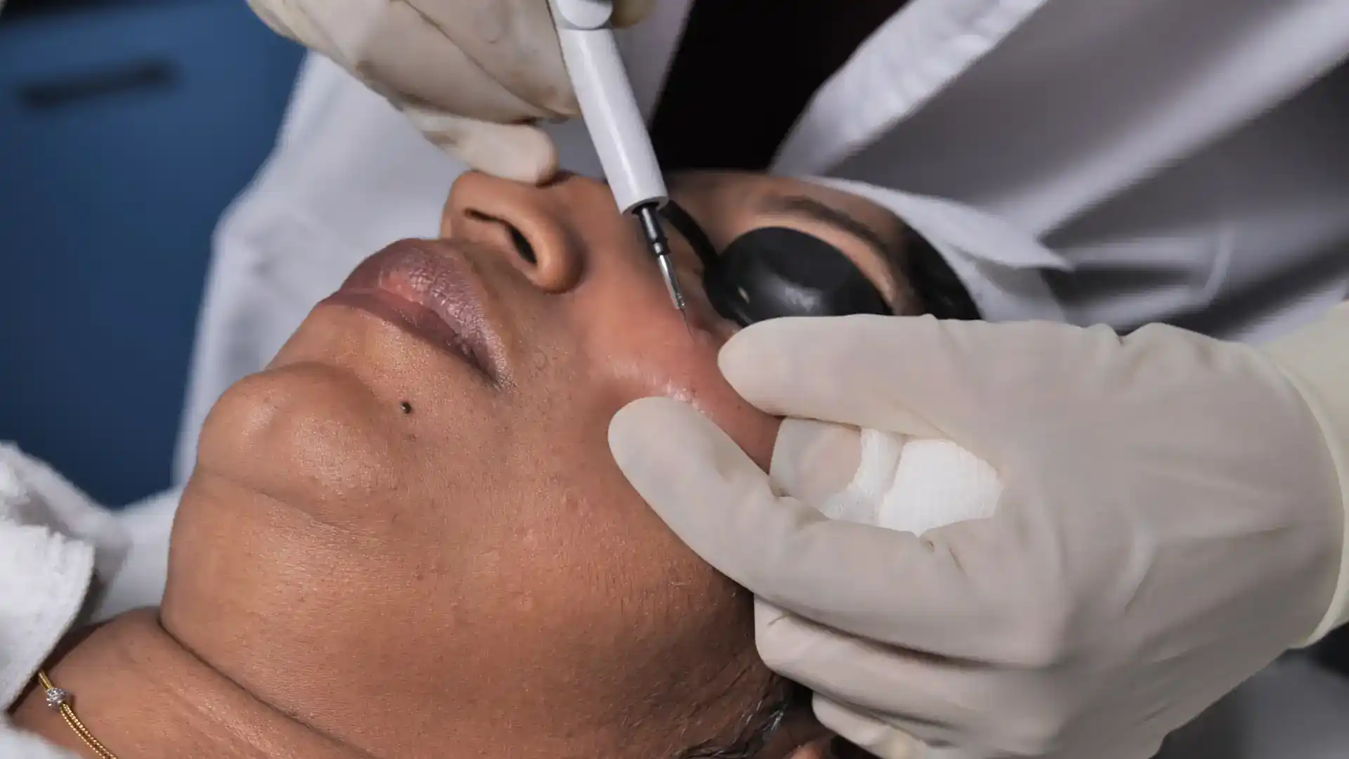 Key Benefits of Mole, Wart, and Skin Tag Removal - DermaVue