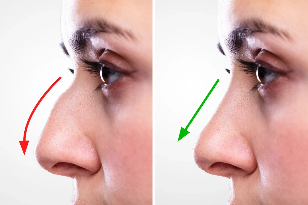 Key Benefits of Nose Reshaping/Rhinoplasty - Aesthetic Improvement and Enhanced Facial Harmony