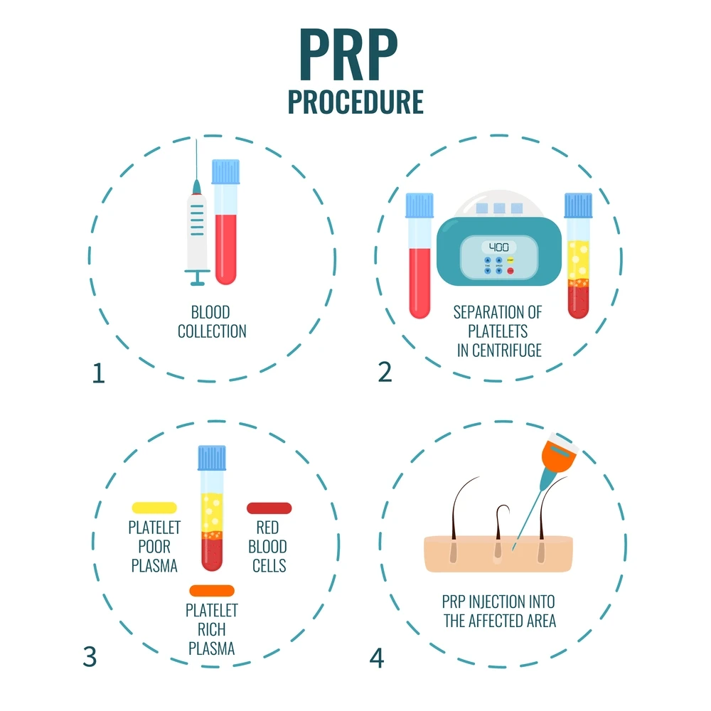 PRP Procedure for Hair Loss - DermaVue