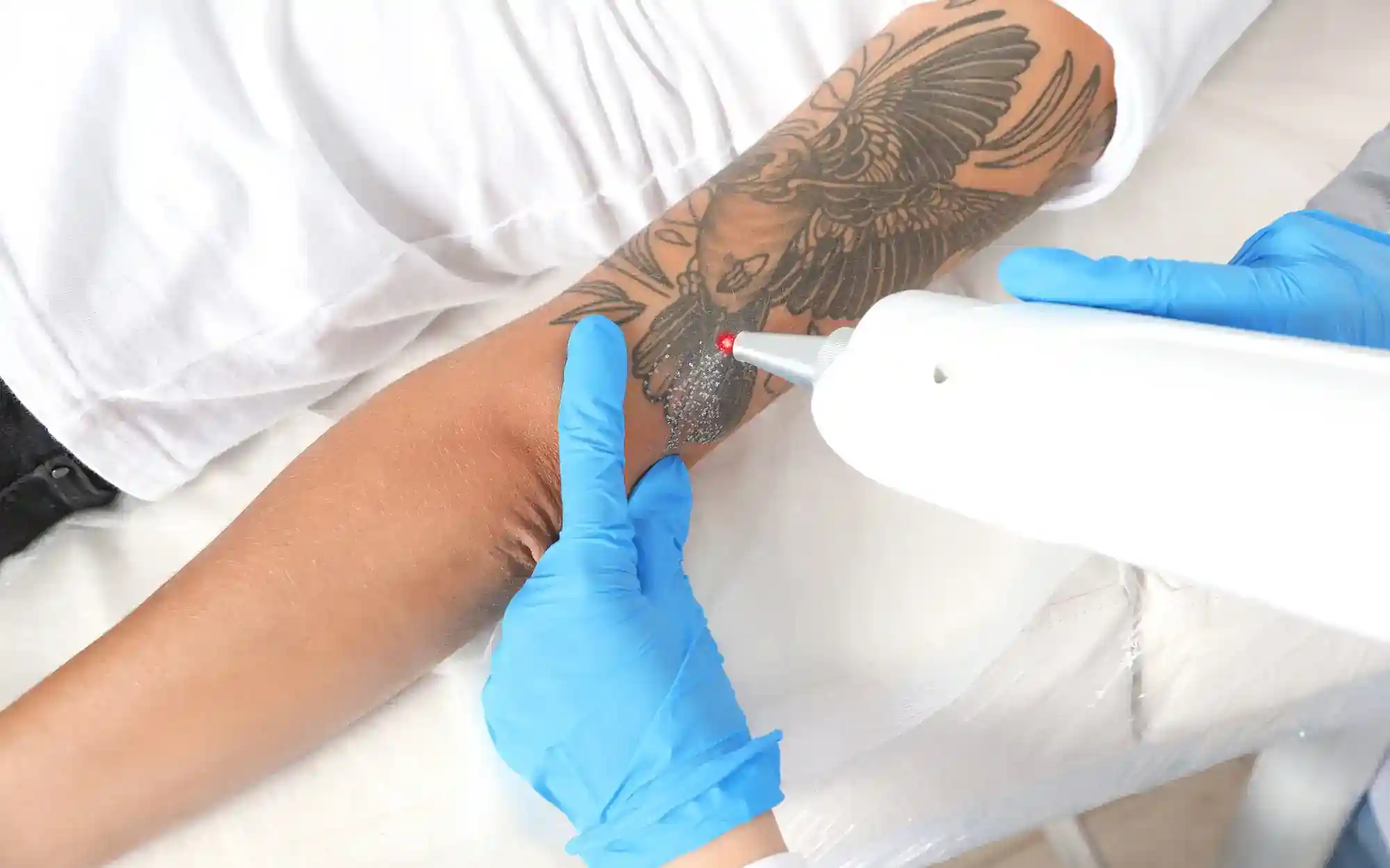 Laser tattoo removal by dermatologist Dr. Joel Schlessinge… | Flickr