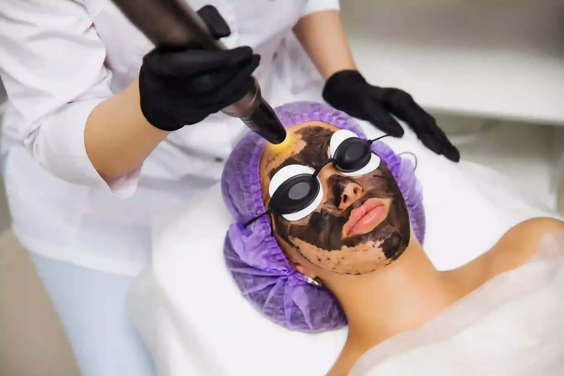 Woman undergoing Carbon Laser Peel treatment at Dermavue clinic