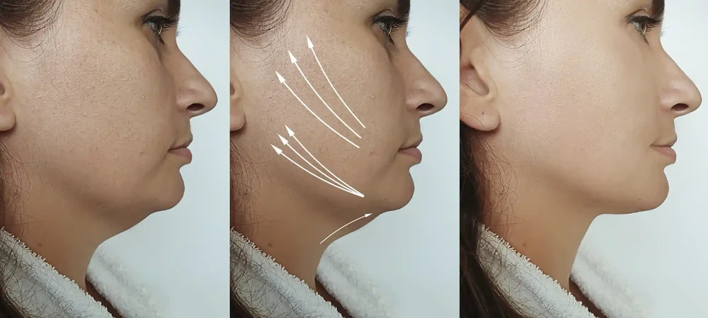 Non-Surgical Jawline and Chin Contouring - Enhance Your Profile with FDA-Approved Fillers