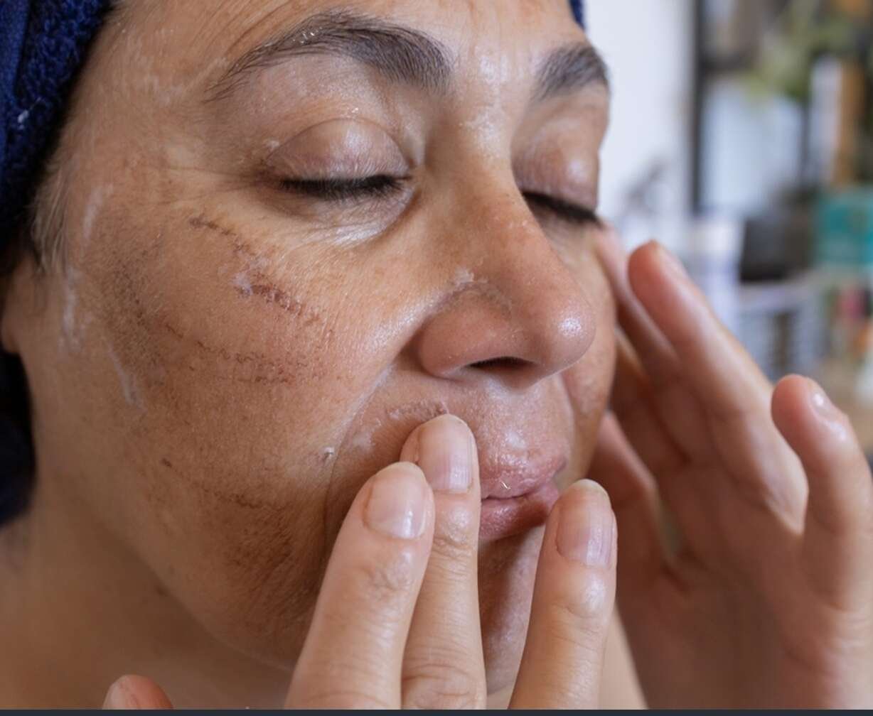 Woman undergoing enzyme peel treatment for radiant skin at a dermatology clinic