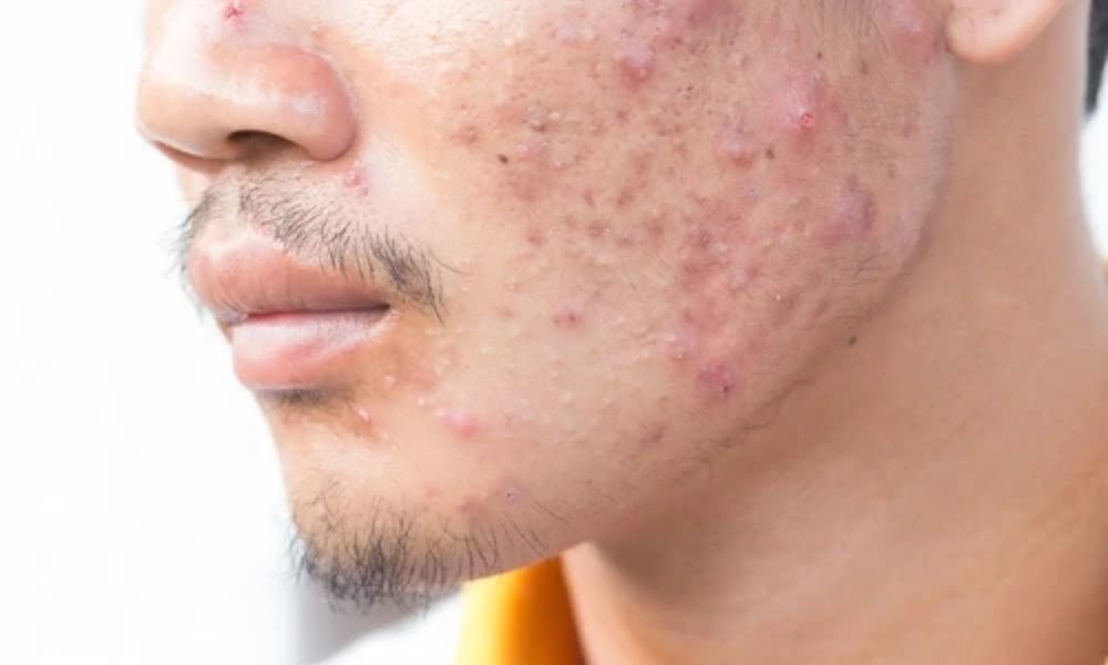 Acne Treatment — DermaVue Thiruvalla