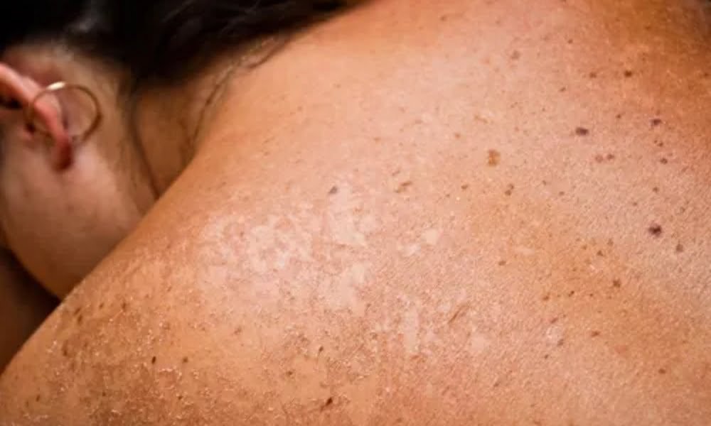 Fungal Infection Treatment — DermaVue Thiruvalla