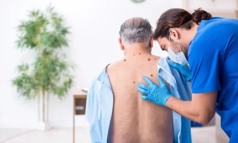 Wart & Skin Tag Removal at DermaVue Thiruvalla