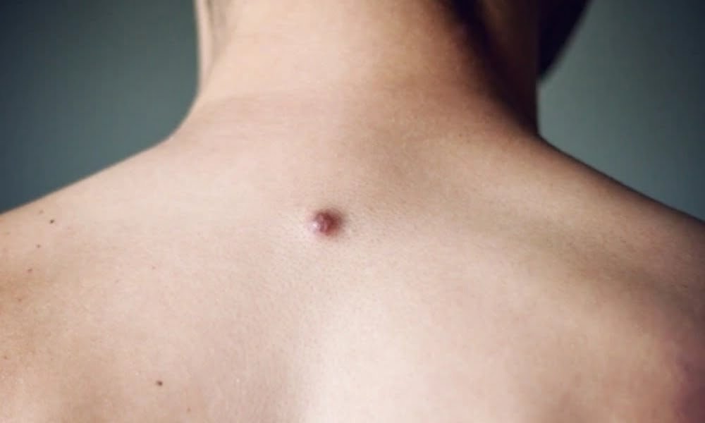 Dermatologist-led cryotherapy, RFA, electrocautery and intralesional bleomycin wart removal at DermaVue Kollam, Kavanad