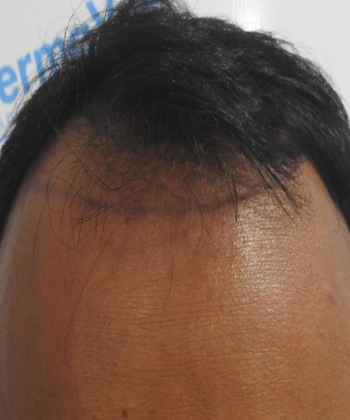 Hair Loss Treatment in Coimbatore | Expert Care at DermaVue, Hair Loss Treatment in Thrissur