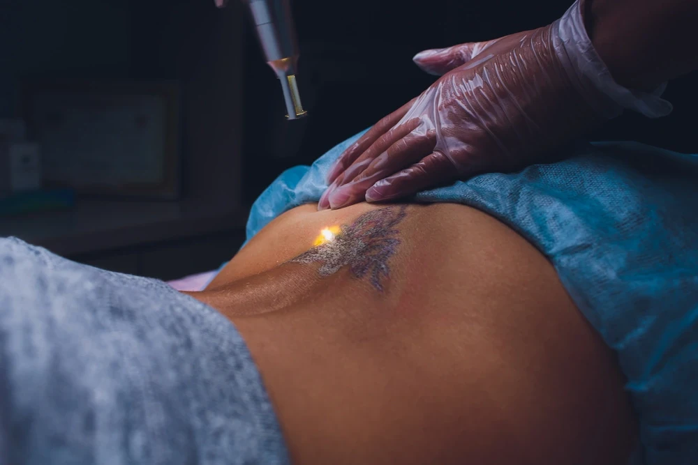 tattoo removal clinic Coimbatore