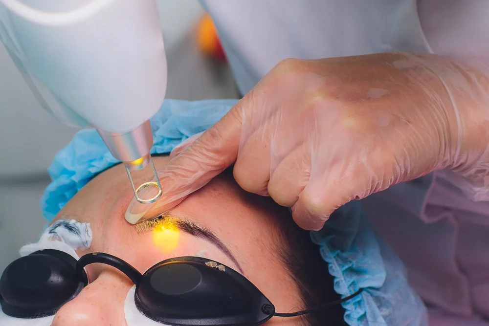 Mole, Wart & Skin Tag Removal | DermaVue Coimbatore