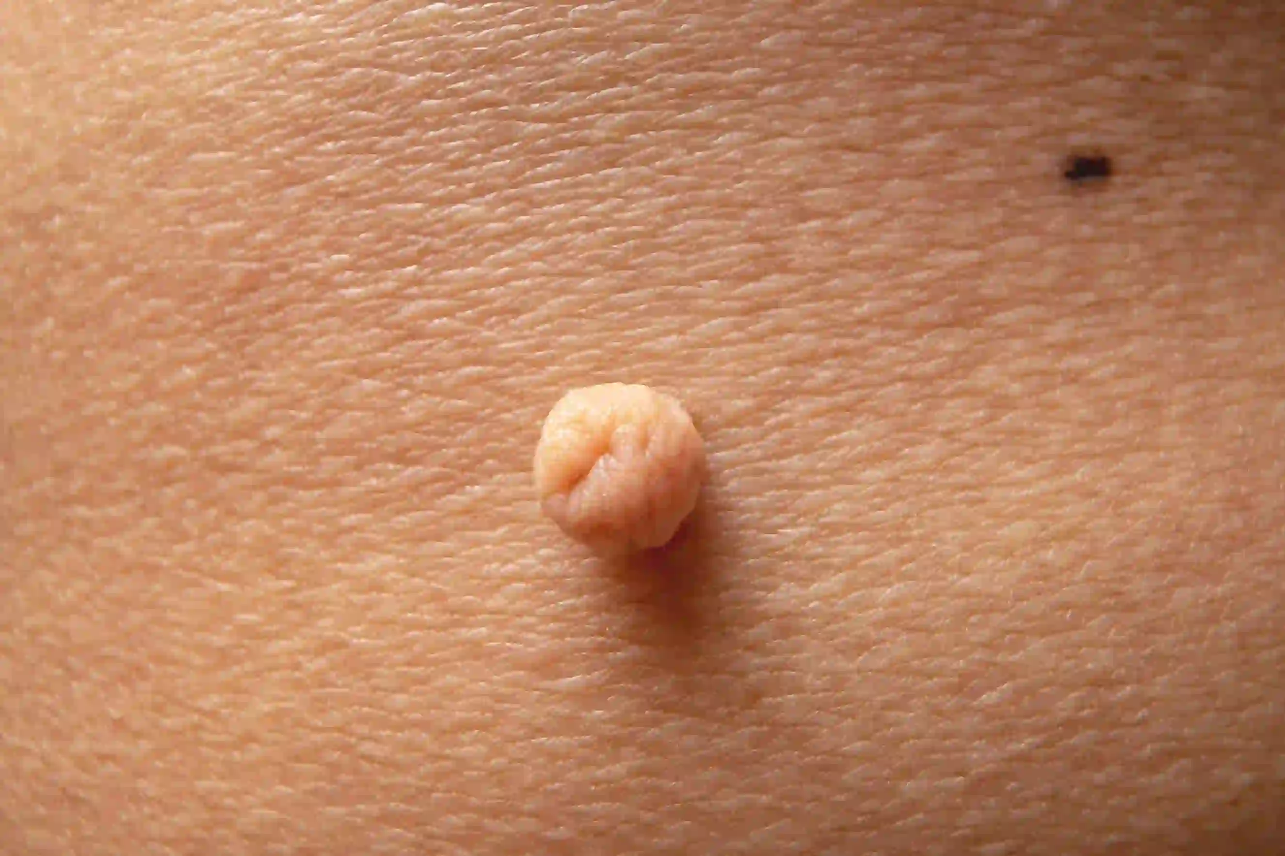Procedures- DermaVue-skin-clinic-best-dermatologist-in-kerala-expert-care-lasers-cosmetology-hair transplant- _5