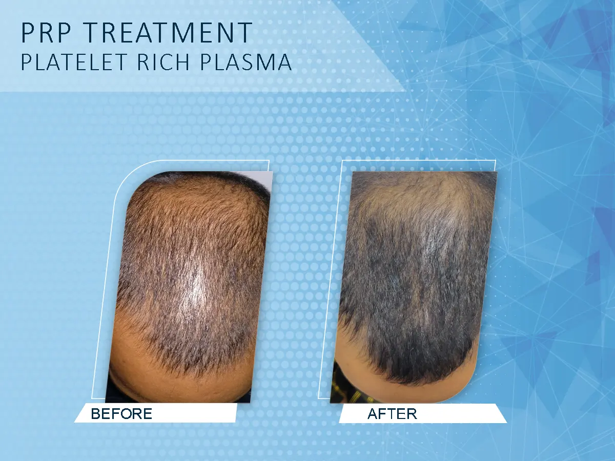 PRP Hair Treatment in Coimbatore