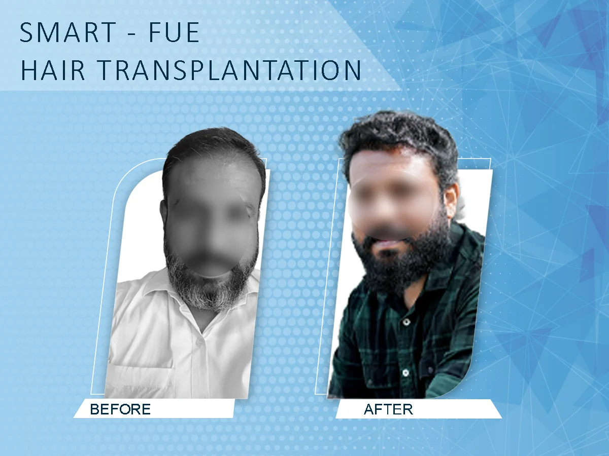 Advanced laser technology at DermaVue Coimbatore