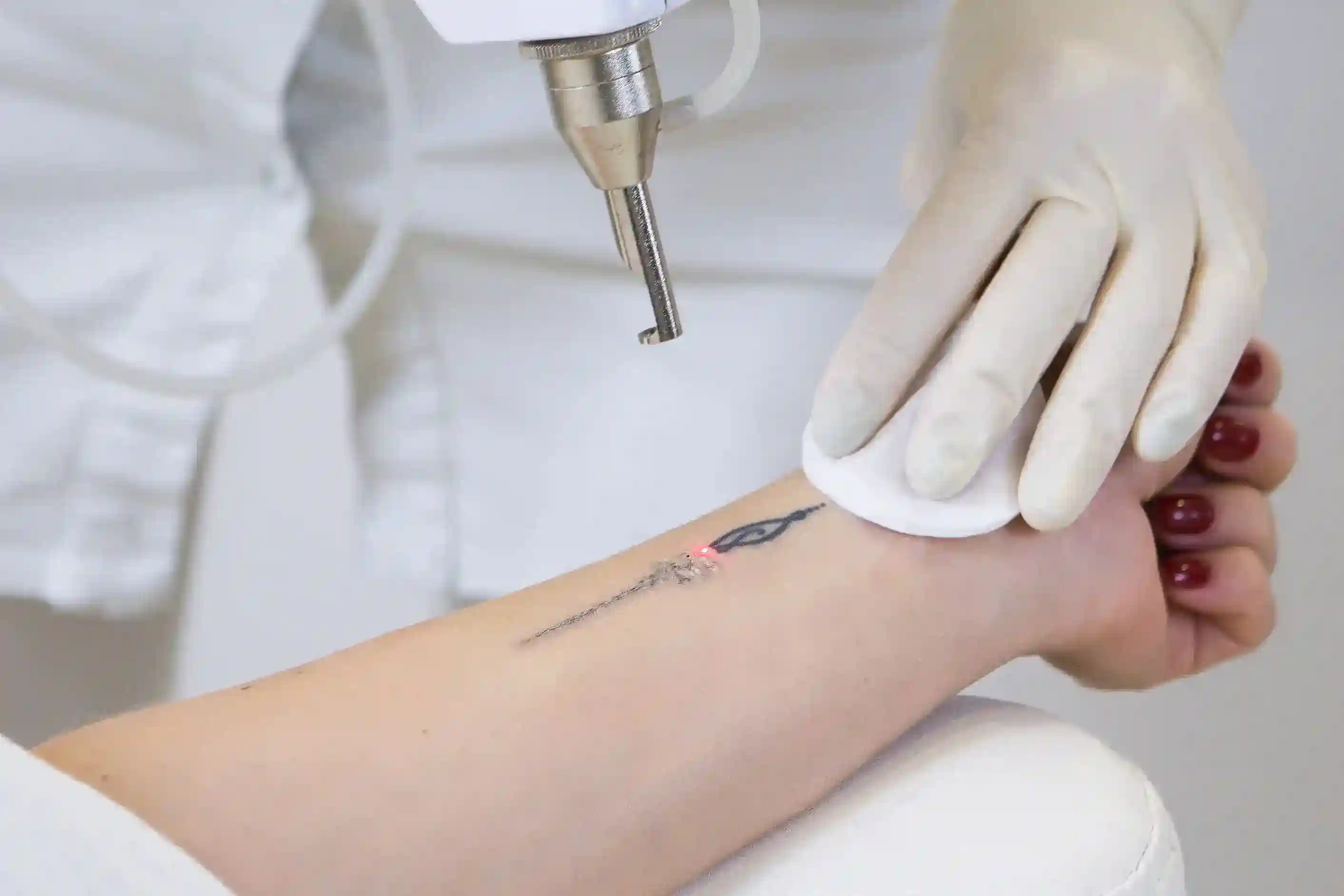 Top-Rated Laser Tattoo Removal in Coimbatore