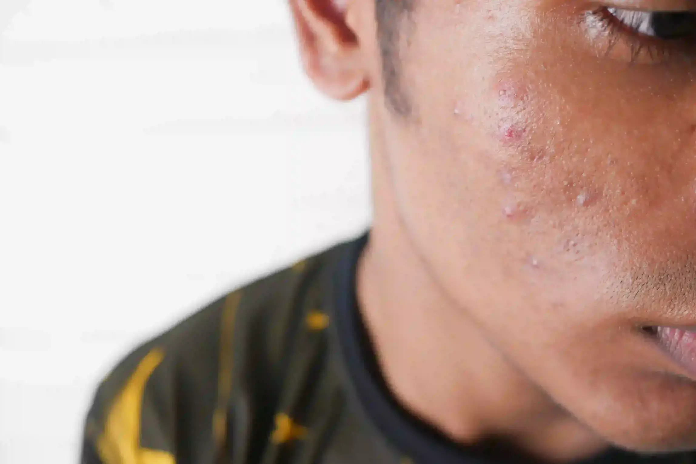 Acne Treatment in Coimbatore