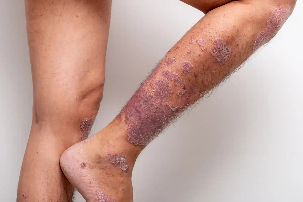 DERMATOLGIST-COIMBATORE-DERMAVUE_62