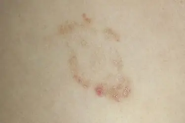 Ringworm Treatment