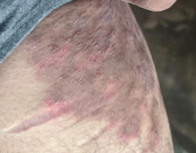 DERMATOLGIST-COIMBATORE-DERMAVUE_80