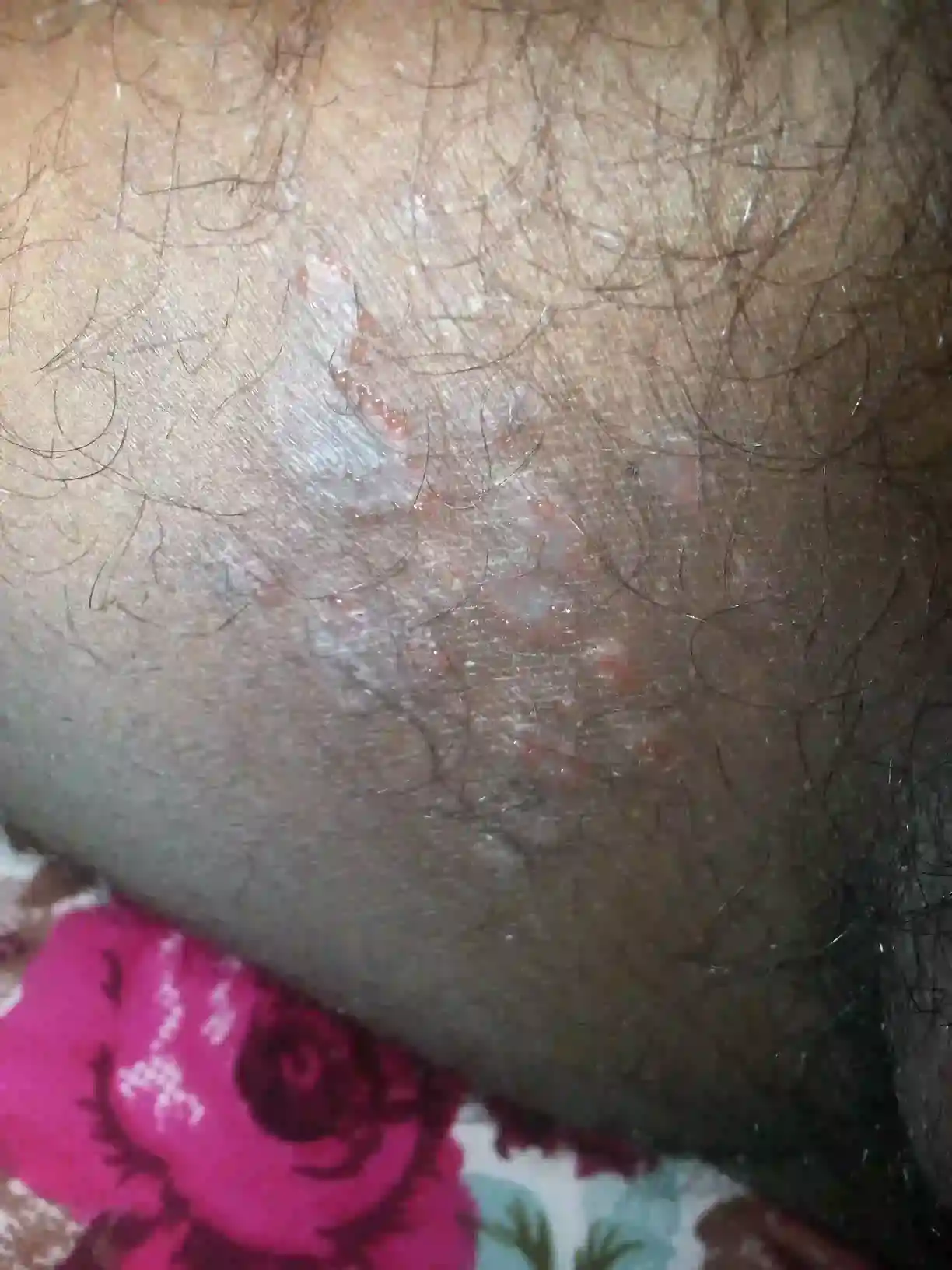 Ringworm Treatment