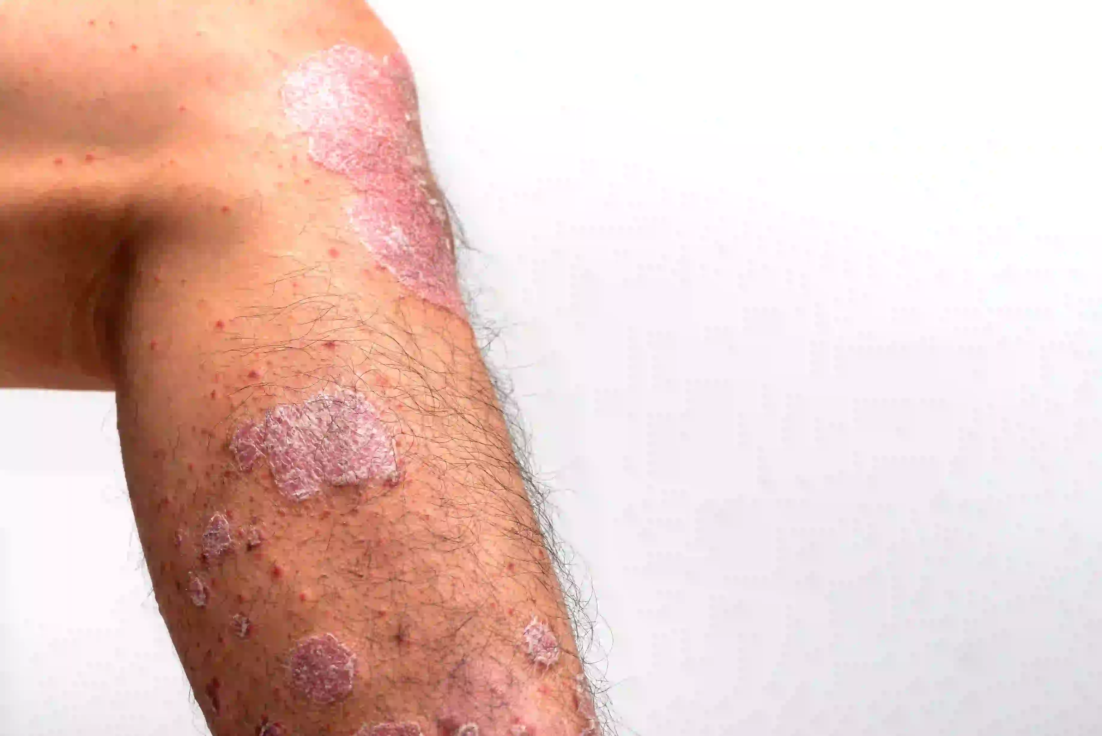 DERMATOLGIST-COIMBATORE-DERMAVUE_90
