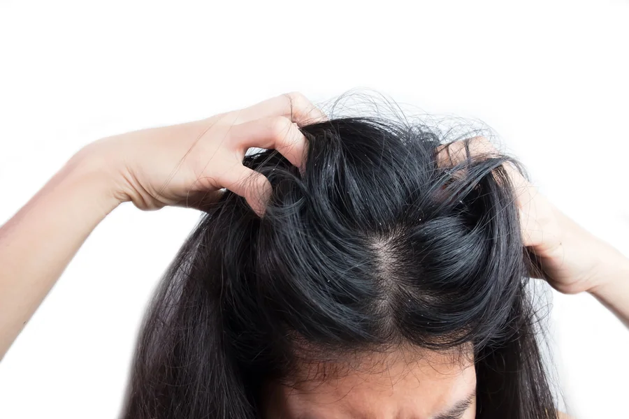 Best Dandruff Treatment in Thrissur | Seborrheic Dermatitis Care