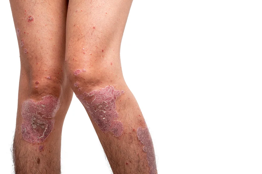 DERMATOLGIST-THRISSUR-COMMON-SKIN CONDITIONS-DERMAVUE_58