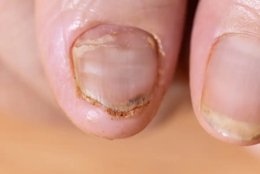 Fungal Infection & Ringworm Treatment in Thrissur | Fast 3-Day Relief
