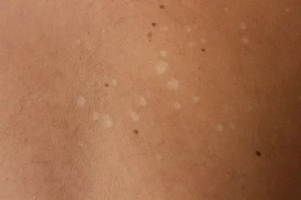 DERMATOLGIST-THRISSUR-COMMON-SKIN CONDITIONS-DERMAVUE_7