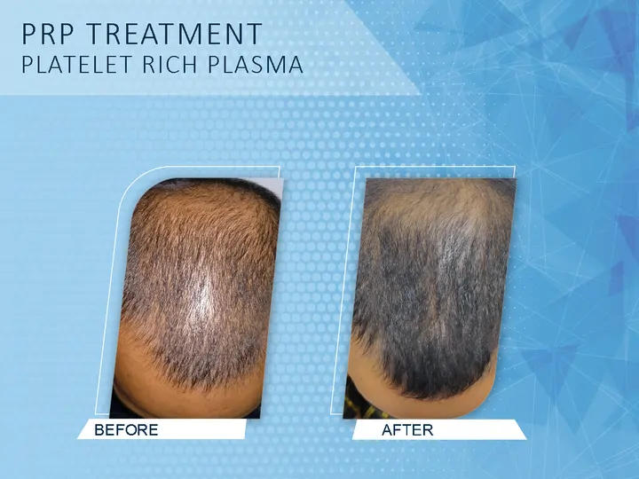 GFC & PRP Hair Treatment in Kollam