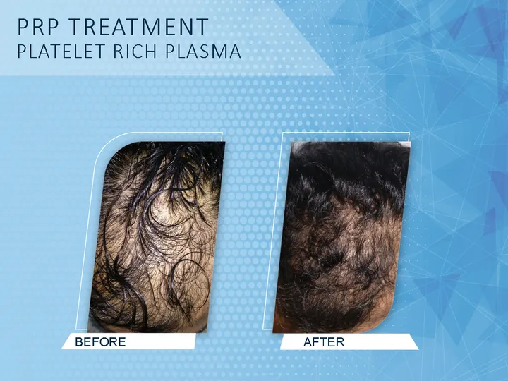 GFC & PRP Hair Treatment in Kollam | Expert Care - DermaVue