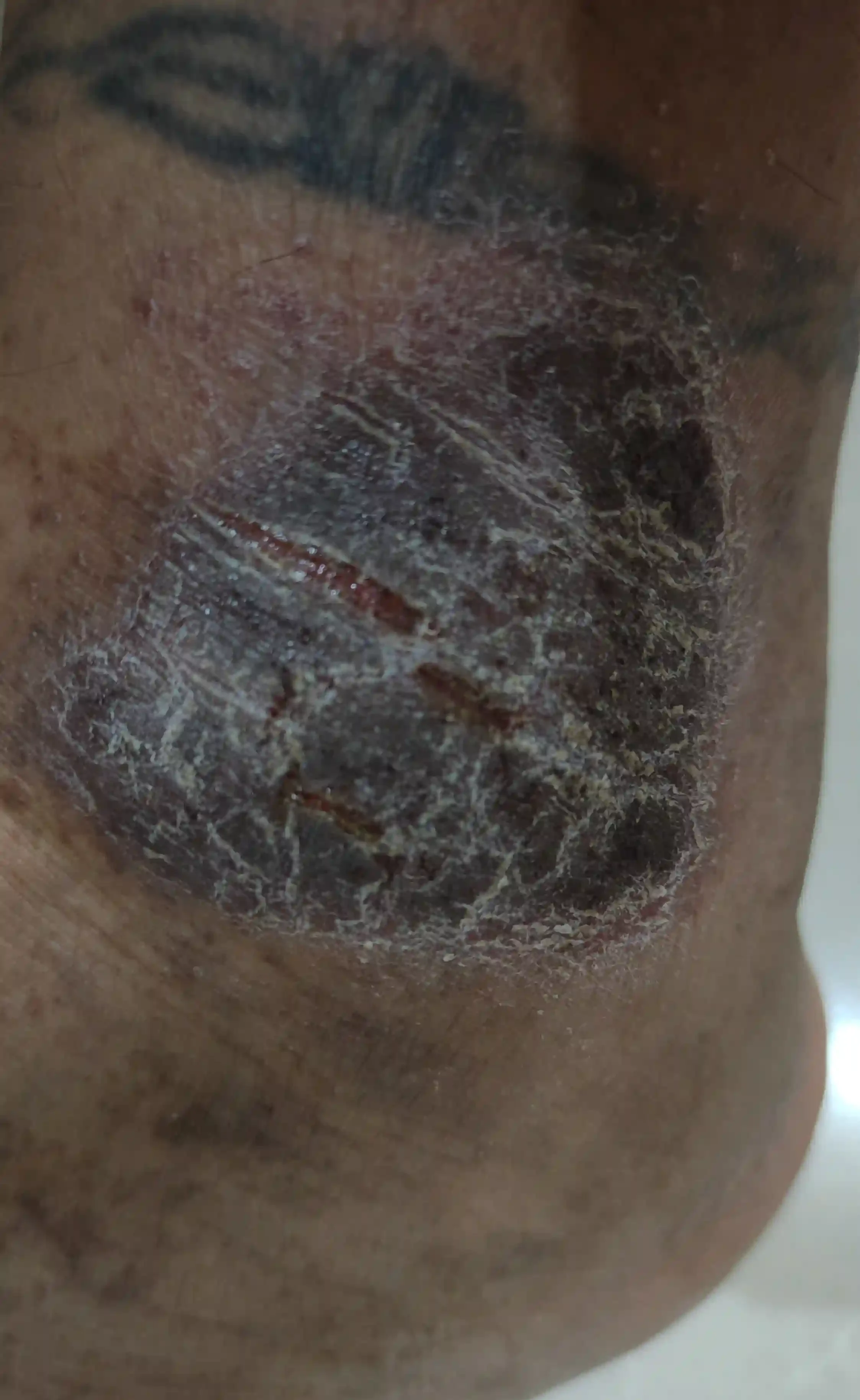 Eczema Treatment in Kollam | Expert Care at DermaVue Skin Clinic
