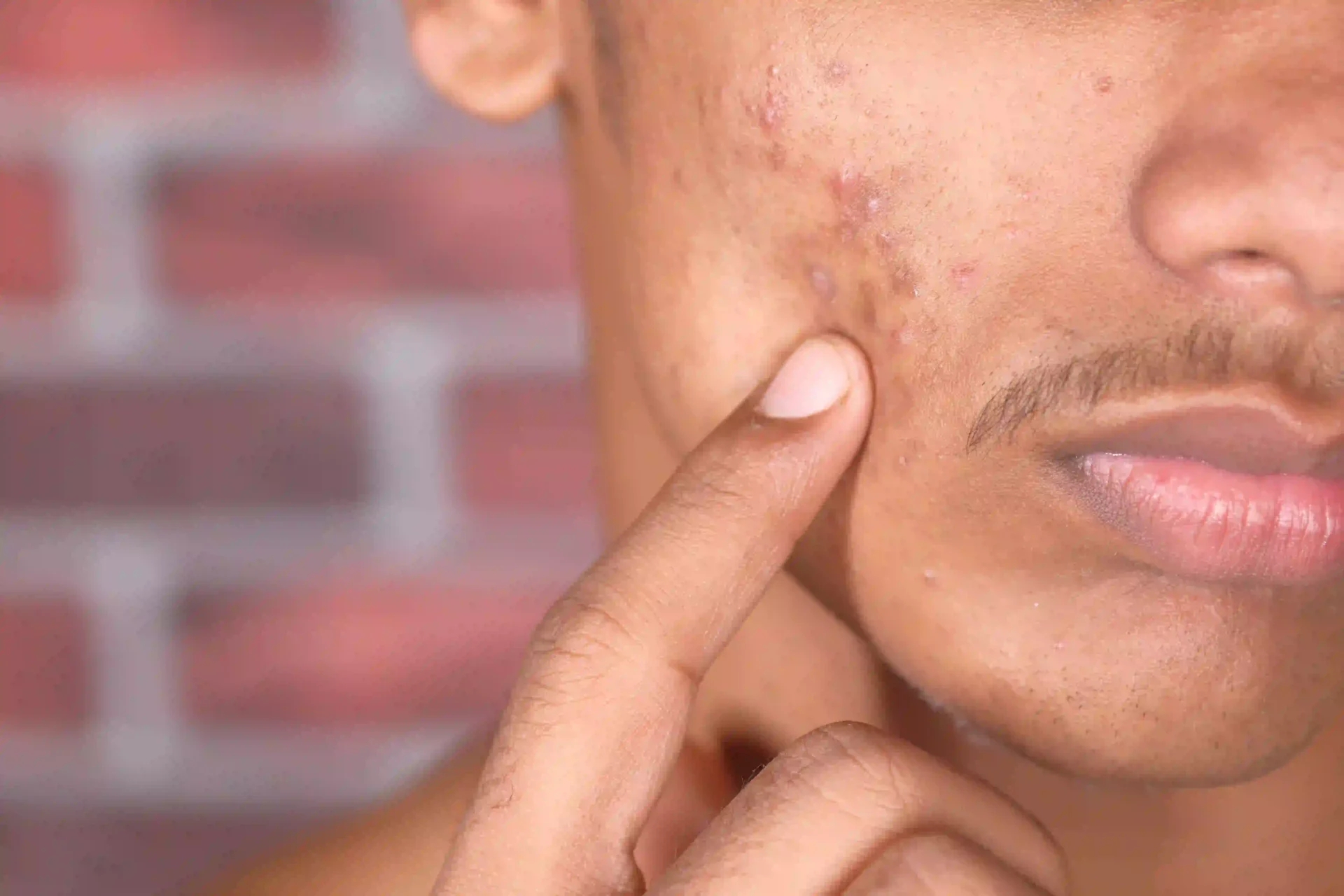 DERMATOLOGIST NEAR ME KOLLAM, KERLA _8 - Acne Scar & Acne Treatment in Kollam | DermaVue Expert Dermatologists