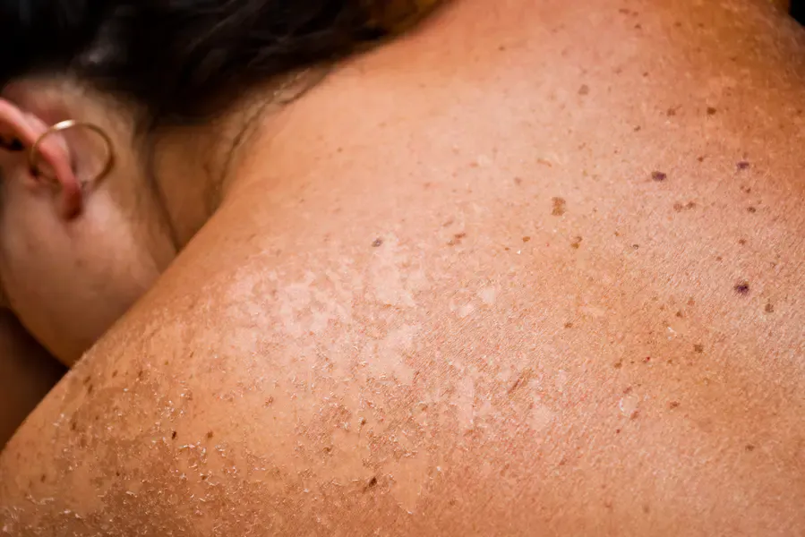 Dermatologist-Kochi-_115- Fungal Infection Treatment Cochin