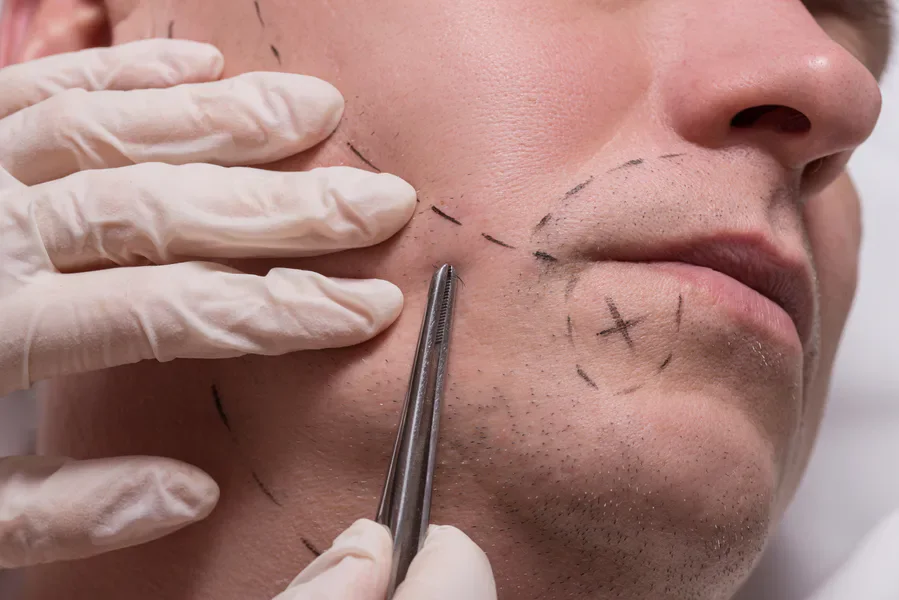 Beard Transplant |Dermatologist-Kochi