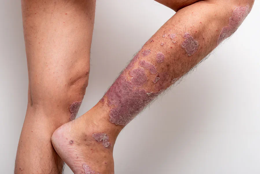 Dermatologist-Kochi-_164-Psoriasis Treatment Cochin