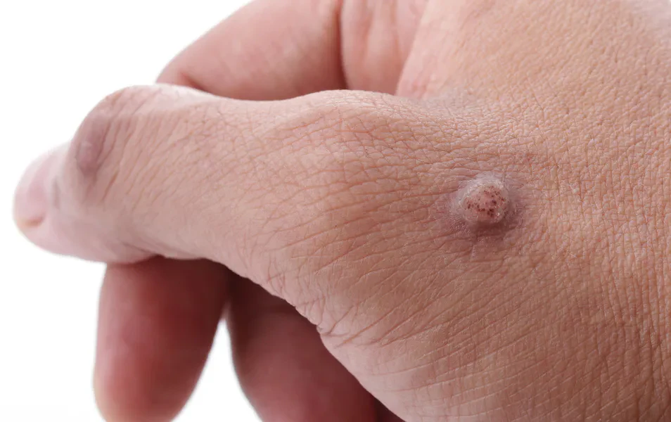 Dermatologist-Kochi-_169-Skin Tag & Wart Removal Cochin