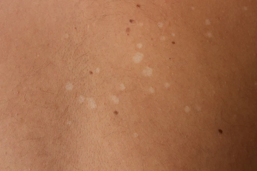 Dermatologist-Kochi-_170